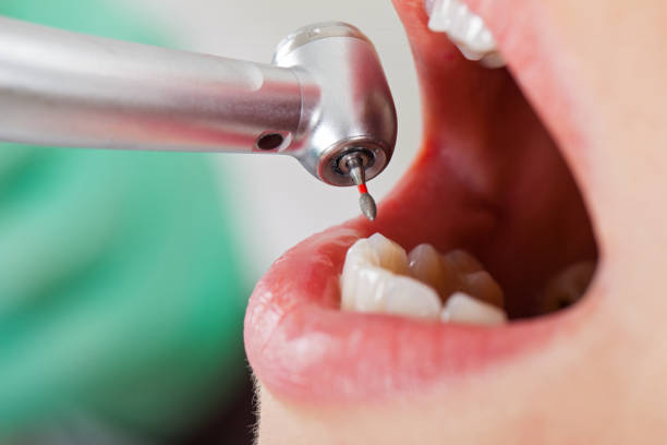 Best Emergency Dentist for Knocked-Out Tooth in Lewiston, CA